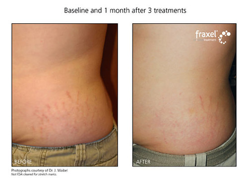 Fraxel for Stomach Stretch Marks (Cosmopolitan Skin Care Solutions)