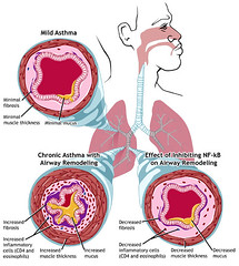 Asthma: Mild and Chronic