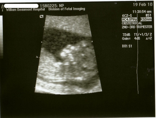 ultrasound 12 weeks 2