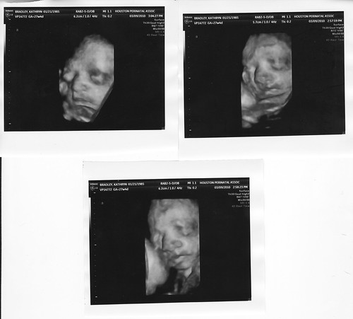 ultrasound 27 weeks