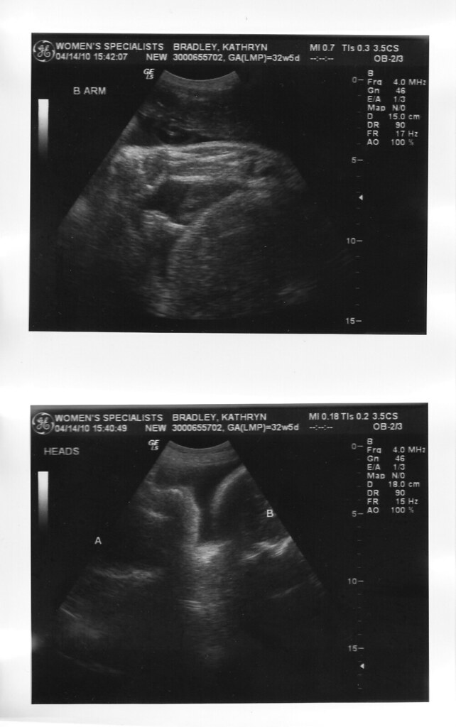 ultrasounds 32 weeks_0004