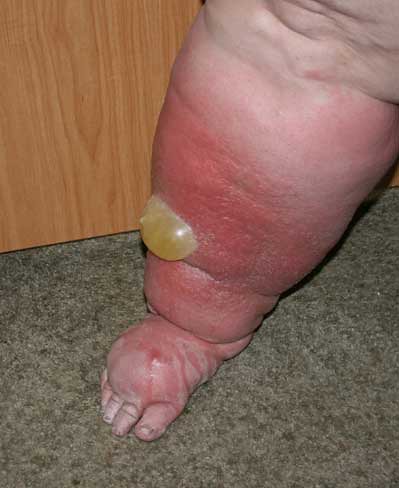 Edema In Legs. Edema is the term doctors use