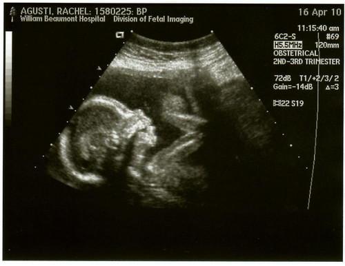 ultrasound 20 weeks