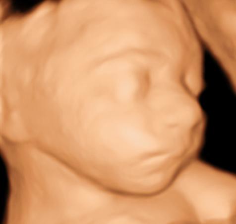 3d ultrasound pictures at 26 weeks. 3D Sono Image | 3D Ultrasound