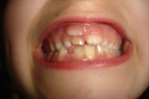 Corinne's Tooth