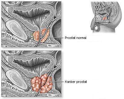 prostate cancer, types of cancer, 