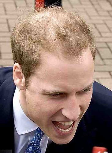 is prince william bald. is prince william bald.
