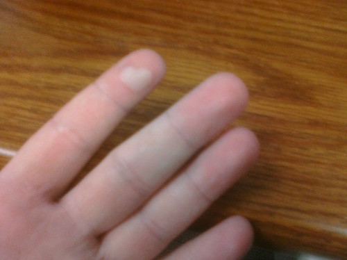 Ptw Burned  my finger on stove the other day. Blister in shape of Heart.