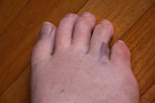a broken toe?