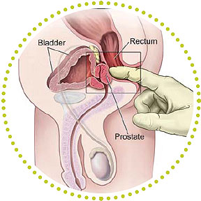 prostate cancer, types of cancer, 