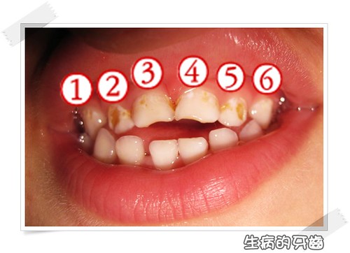 101110-生病的牙齒