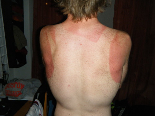 My Back after the ironman