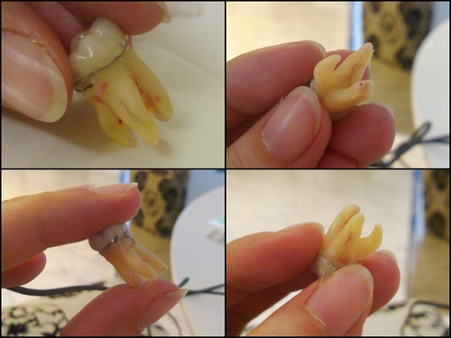 Suanie's extracted tooth