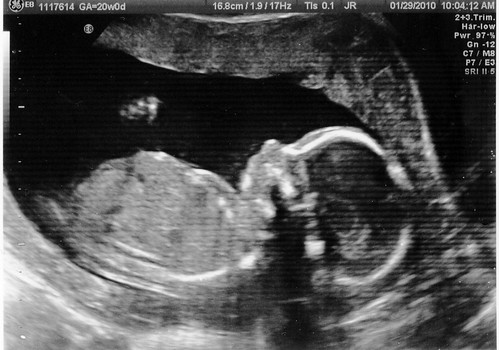 20 Week Ultrasound! (cropped)