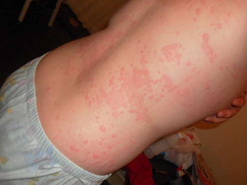 Skin Allergy Symptoms, Diagnosis, Treatment ... - AAAAI