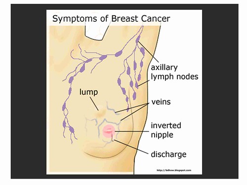 breast cancer symptoms. 005 reast cancer symptoms. Advocacy campaign on reast cancer,