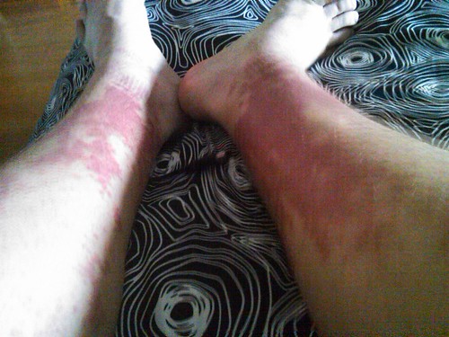 baby heat rash treatment. Heat+rashes+on+legs
