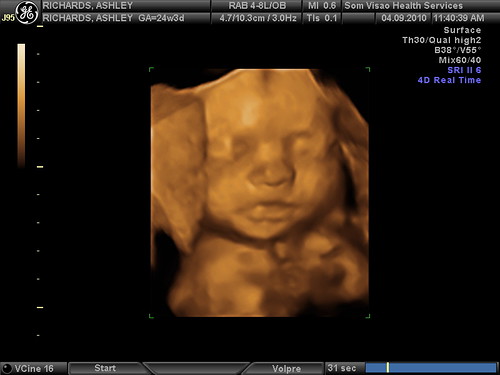 3D Ultrasound Still