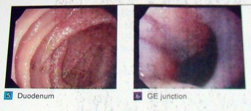 Duodenum and GE Junction