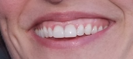 teeth-with-veneers_03-13-10