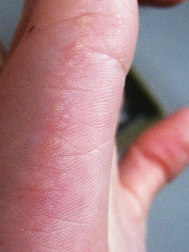 scabies on hands. on the palms of her hands.