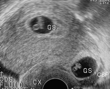  Hysteroscopic management of heterotopic cesarean scar pregnancy Fertility and Sterility September 2010 (Vol 94 Issue 4 Pages 1529e15-1529e18) Volume 94 Issue 4 Pages 1529e15-1529e18 (September 2010) httpwwwfertstertorgPhoenixWebPhoe by babymaker