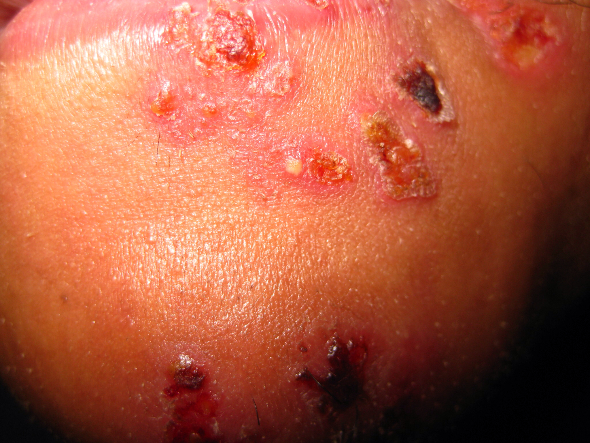 Compare 8 Systemic Fungal Infection Medications - Drugs.com