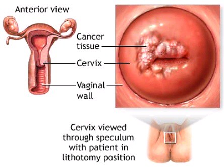 types cancer.cervix