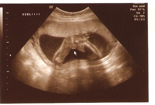ultrasound 3.2