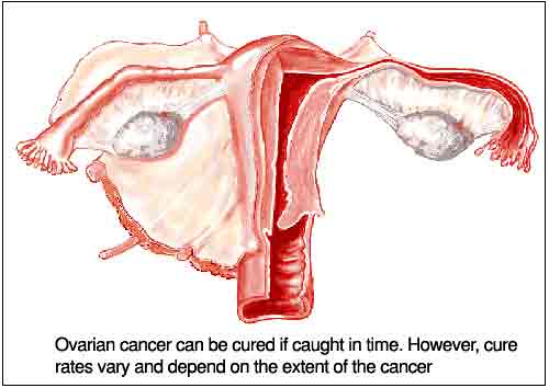 ovarian cancer symptoms2