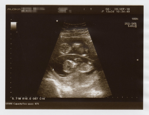 12 5 week ultrasound. 12 Weeks Ultrasound