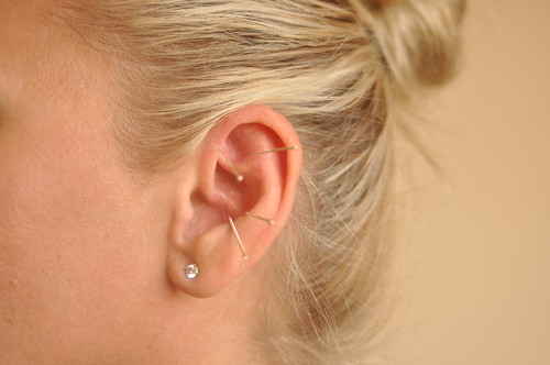 Q&A: Could an ear piercing cause problems with acupuncture points?