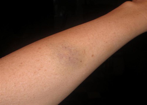 arm_bruise 07-10 (Medium)