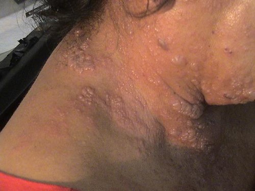 herpes zoster face. Herpes Zoster in face and neck