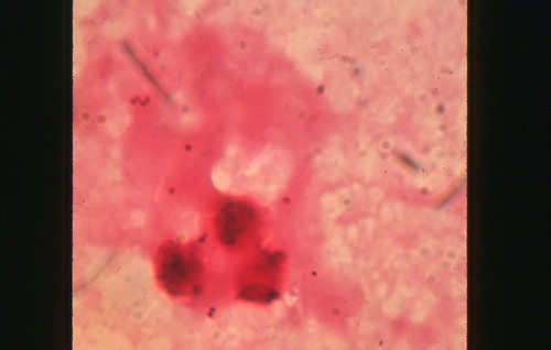 b661-3 Neisseria meningitidis in sputum. Gram stain (1000X)