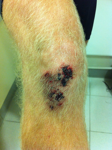 Andy's injuries 3