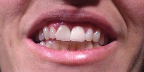 teeth-with-bridges_08-04-10