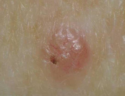 skin cancer symptoms pictures