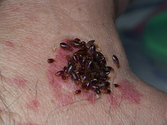 Symptoms Of Bed Bug Bites And Pictures