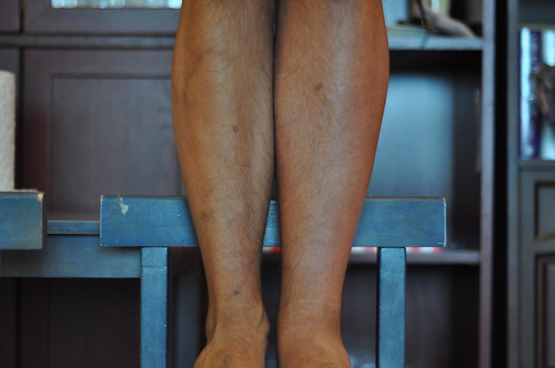 leg swollen