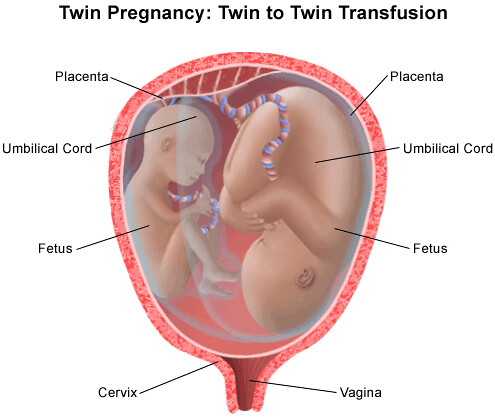 signs-twin-pregnancy