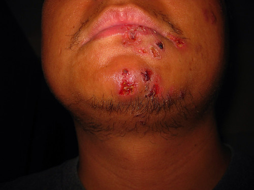 herpes symptoms lips. symptoms of herpes by brownpau