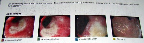 Ulcer and Stomach