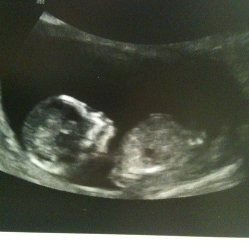 12 5 week ultrasound. 12 (+) weeks ultrasound