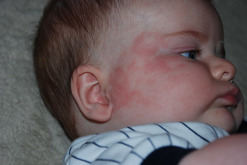 Milk Allergy? - BabyCenter