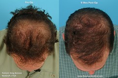 &Quot;Fue&Quot; - Follicular Unit Extraction With Neograft - -