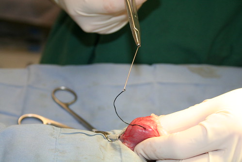 Needle Foreign Body - removed