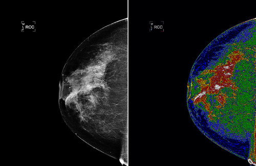 NASA Technology Could Aid in Interpretation of Mammograms