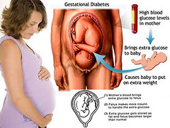 treating Gestational Diabetes