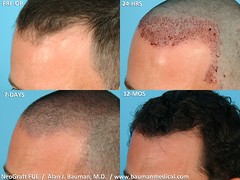 &Quot;Fue&Quot; - Follicular Unit Extraction With Neograft - -